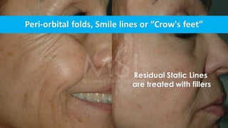 ADVANCED BOTOX COURSE.PART II. HOW TO INJECT BOTOX SAFELY?