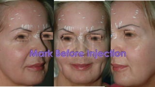 ADVANCED BOTOX COURSE.PART II. HOW TO INJECT BOTOX SAFELY?
