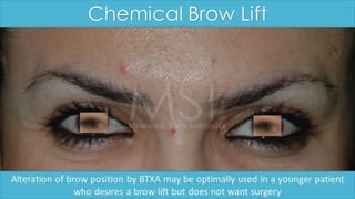 ADVANCED BOTOX COURSE.PART II. HOW TO INJECT BOTOX SAFELY?