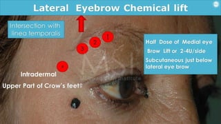 ADVANCED BOTOX COURSE.PART II. HOW TO INJECT BOTOX SAFELY?