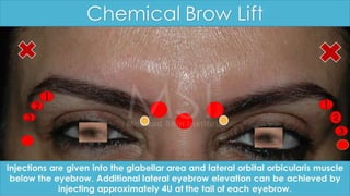 ADVANCED BOTOX COURSE.PART II. HOW TO INJECT BOTOX SAFELY?