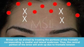 ADVANCED BOTOX COURSE.PART II. HOW TO INJECT BOTOX SAFELY?