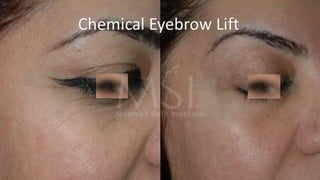 ADVANCED BOTOX COURSE.PART II. HOW TO INJECT BOTOX SAFELY?