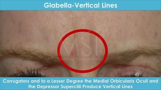 ADVANCED BOTOX COURSE.PART II. HOW TO INJECT BOTOX SAFELY?