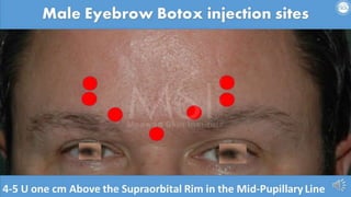 ADVANCED BOTOX COURSE.PART II. HOW TO INJECT BOTOX SAFELY?