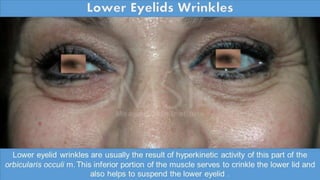 ADVANCED BOTOX COURSE.PART II. HOW TO INJECT BOTOX SAFELY?