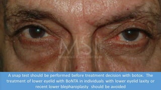 ADVANCED BOTOX COURSE.PART II. HOW TO INJECT BOTOX SAFELY?