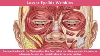 ADVANCED BOTOX COURSE.PART II. HOW TO INJECT BOTOX SAFELY?
