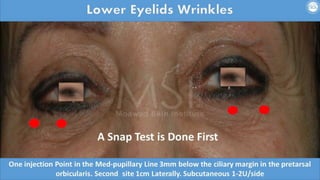 ADVANCED BOTOX COURSE.PART II. HOW TO INJECT BOTOX SAFELY?