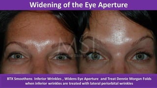 ADVANCED BOTOX COURSE.PART II. HOW TO INJECT BOTOX SAFELY?