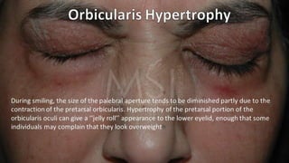 ADVANCED BOTOX COURSE.PART II. HOW TO INJECT BOTOX SAFELY?