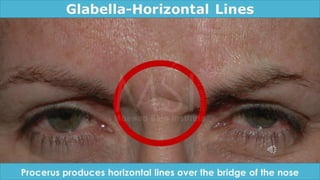 ADVANCED BOTOX COURSE.PART II. HOW TO INJECT BOTOX SAFELY?