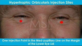 ADVANCED BOTOX COURSE.PART II. HOW TO INJECT BOTOX SAFELY?