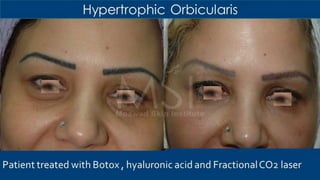 ADVANCED BOTOX COURSE.PART II. HOW TO INJECT BOTOX SAFELY?