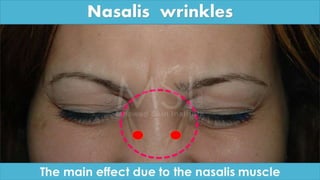 ADVANCED BOTOX COURSE.PART II. HOW TO INJECT BOTOX SAFELY?