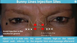 ADVANCED BOTOX COURSE.PART II. HOW TO INJECT BOTOX SAFELY?