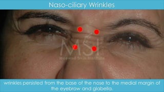 ADVANCED BOTOX COURSE.PART II. HOW TO INJECT BOTOX SAFELY?