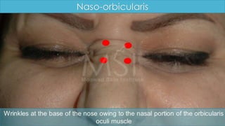 ADVANCED BOTOX COURSE.PART II. HOW TO INJECT BOTOX SAFELY?