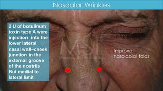 ADVANCED BOTOX COURSE.PART II. HOW TO INJECT BOTOX SAFELY?