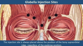 ADVANCED BOTOX COURSE.PART II. HOW TO INJECT BOTOX SAFELY?