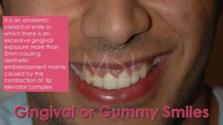 ADVANCED BOTOX COURSE.PART II. HOW TO INJECT BOTOX SAFELY?