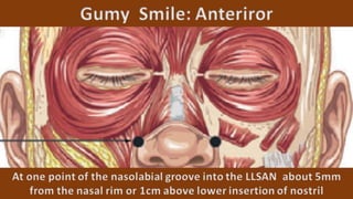 ADVANCED BOTOX COURSE.PART II. HOW TO INJECT BOTOX SAFELY?