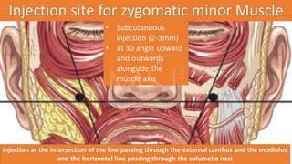 ADVANCED BOTOX COURSE.PART II. HOW TO INJECT BOTOX SAFELY?