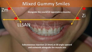 ADVANCED BOTOX COURSE.PART II. HOW TO INJECT BOTOX SAFELY?