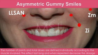 ADVANCED BOTOX COURSE.PART II. HOW TO INJECT BOTOX SAFELY?