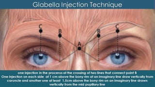 ADVANCED BOTOX COURSE.PART II. HOW TO INJECT BOTOX SAFELY?