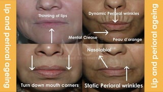 ADVANCED BOTOX COURSE.PART II. HOW TO INJECT BOTOX SAFELY?