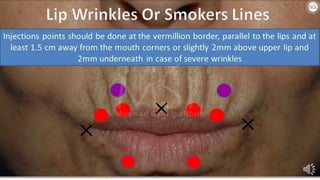 ADVANCED BOTOX COURSE.PART II. HOW TO INJECT BOTOX SAFELY?