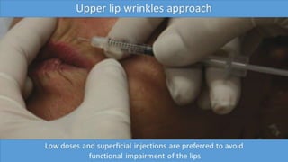 ADVANCED BOTOX COURSE.PART II. HOW TO INJECT BOTOX SAFELY?