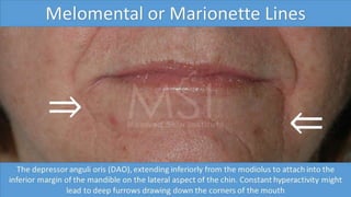 ADVANCED BOTOX COURSE.PART II. HOW TO INJECT BOTOX SAFELY?