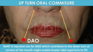 ADVANCED BOTOX COURSE.PART II. HOW TO INJECT BOTOX SAFELY?