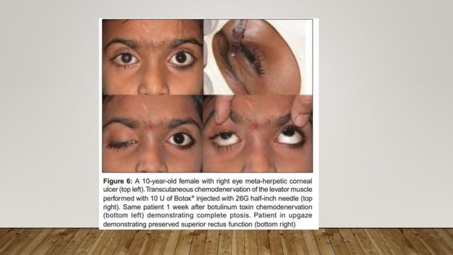 Botox | PPTX | Brain and Nervous System Disorders | Diseases and Conditions