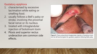 Gustatory epiphora
1. characterised by excessive
lacrimation while eating or
smelling food.
2. usually follows a Bell’s palsy or
stroke, involving the proximal
facial nerve or its nucleus.
3. treated with intraglandular
injection of botulinum toxin
4. Ptosis and superior rectus
underaction are common side
effects.
 
