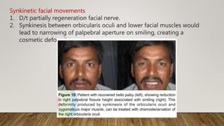 Synkinetic facial movements
1. D/t partially regeneration facial nerve.
2. Synkinesis between orbicularis oculi and lower facial muscles would
lead to narrowing of palpebral aperture on smiling, creating a
cosmetic deformity
 