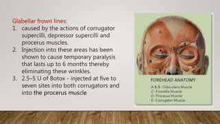 Glabellar frown lines:
1. caused by the actions of corrugator
supercilli, depressor supercilli and
procerus muscles.
2. Injection into these areas has been
shown to cause temporary paralysis
that lasts up to 6 months thereby
eliminating these wrinkles.
3. 2.5–5 U of Botox - injected at five to
seven sites into both corrugators and
into the procerus muscle
 