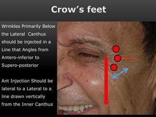 The Art of Liquid Face Lift (Botox) | PPSX