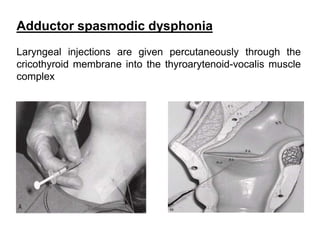 Adductor spasmodic dysphonia
Laryngeal injections are given percutaneously through the
cricothyroid membrane into the thyroarytenoid-vocalis muscle
complex
 
