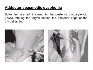 Adductor spasmodic dysphonia
Botox Inj. are administered in the posterior cricoarytenoid
(PCA) rotating the larynx behind the posterior edge of the
thyroid lamina
 