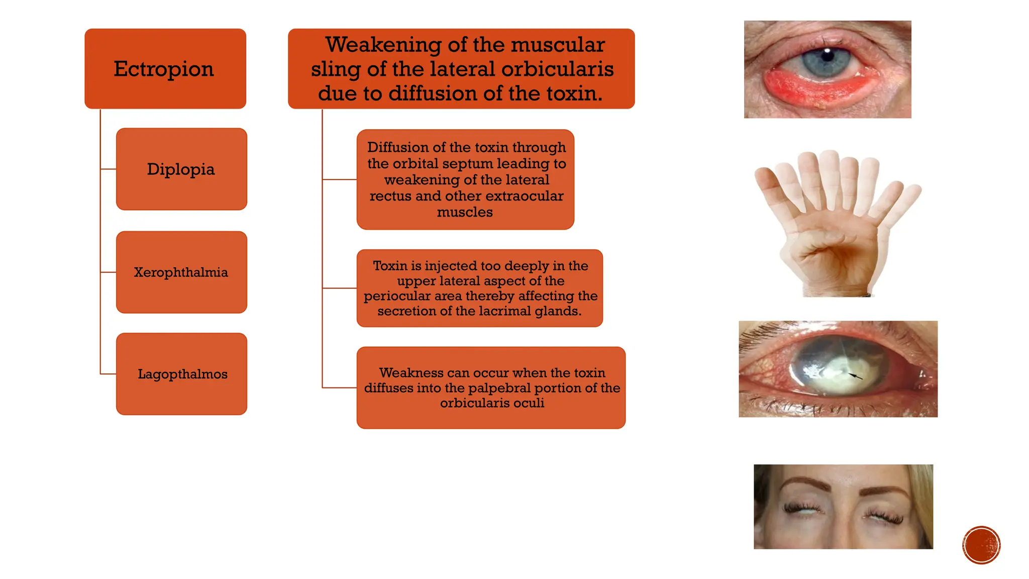 Ectropion
Diplopia
Xerophthalmia
Lagopthalmos
Weakening of the muscular
sling of the lateral orbicularis
due to diffusion of the toxin.
Diffusion of the toxin through
the orbital septum leading to
weakening of the lateral
rectus and other extraocular
muscles
Toxin is injected too deeply in the
upper lateral aspect of the
periocular area thereby affecting the
secretion of the lacrimal glands.
Weakness can occur when the toxin
diffuses into the palpebral portion of the
orbicularis oculi
 