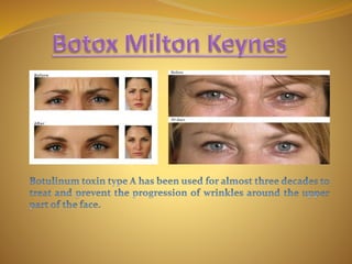 Botox milton keynes