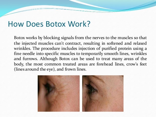 botox nyc by laser touch aesthetics botox how it works