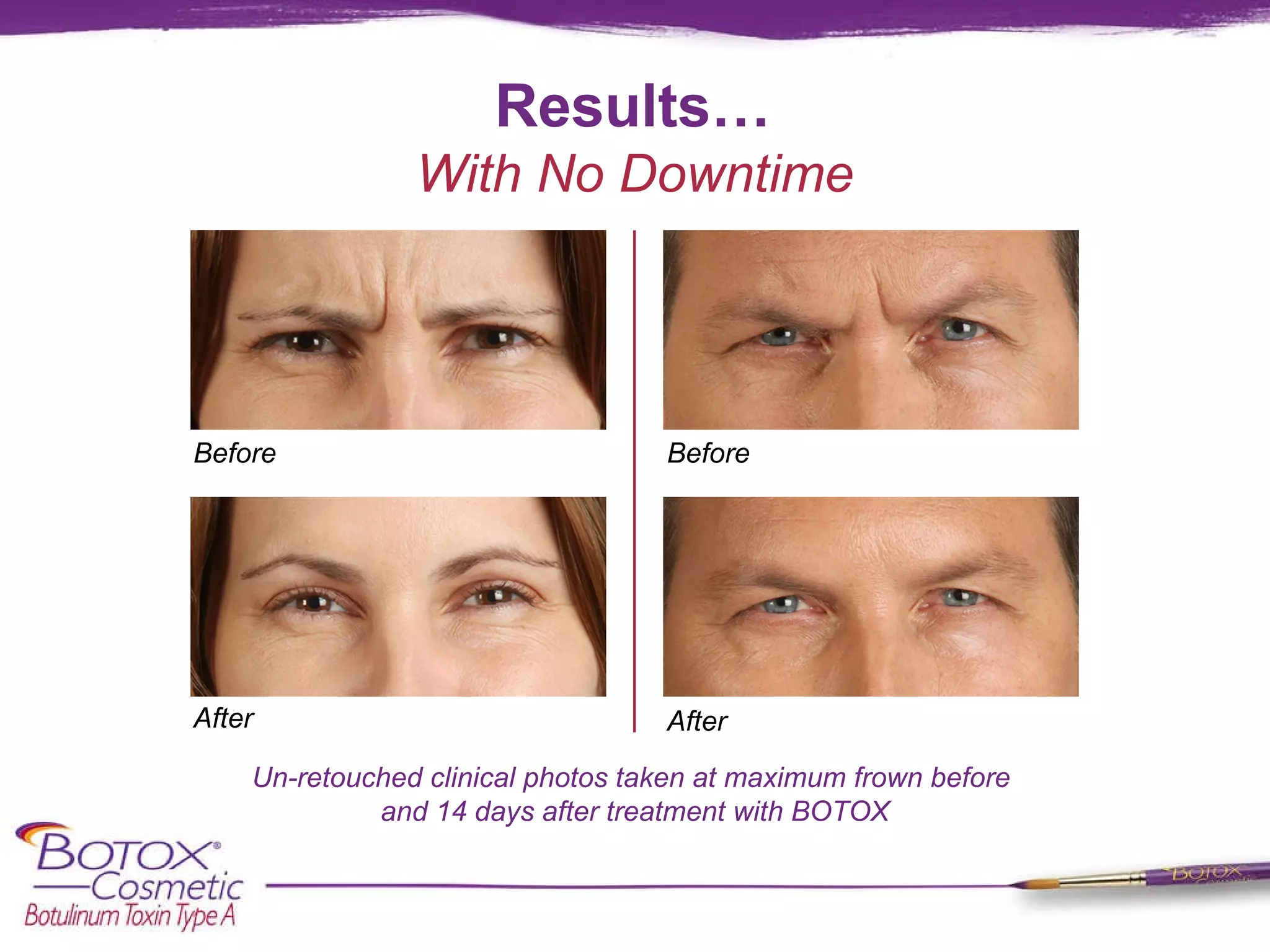 Results… Un-retouched clinical photos taken at maximum frown before  and 14 days after treatment with BOTOX With No Downtime Before After Before After 