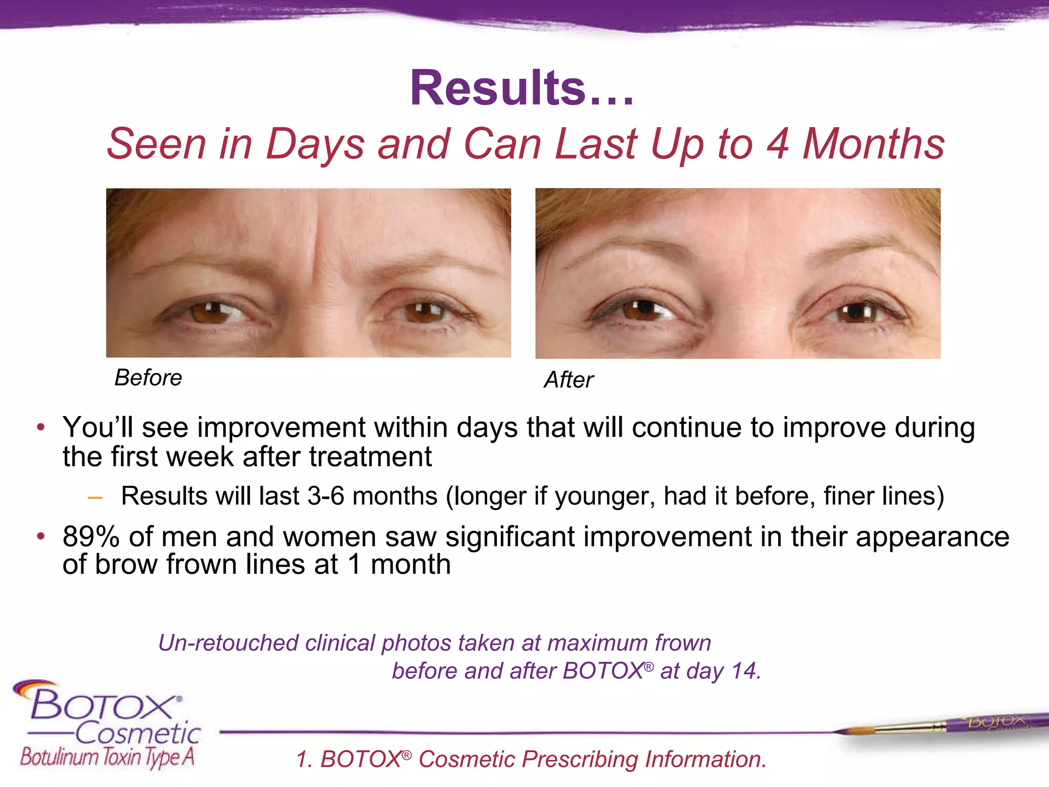 Results… You’ll see improvement within days that will continue to improve during the first week after treatment Results will last 3-6 months (longer if younger, had it before, finer lines) 89% of men and women saw significant improvement in their appearance of brow frown lines at 1 month Un-retouched clinical photos taken at maximum frown  before and after BOTOX ®  at day 14. Seen in Days and Can Last Up to 4 Months 1. BOTOX ®  Cosmetic Prescribing Information. Before After 