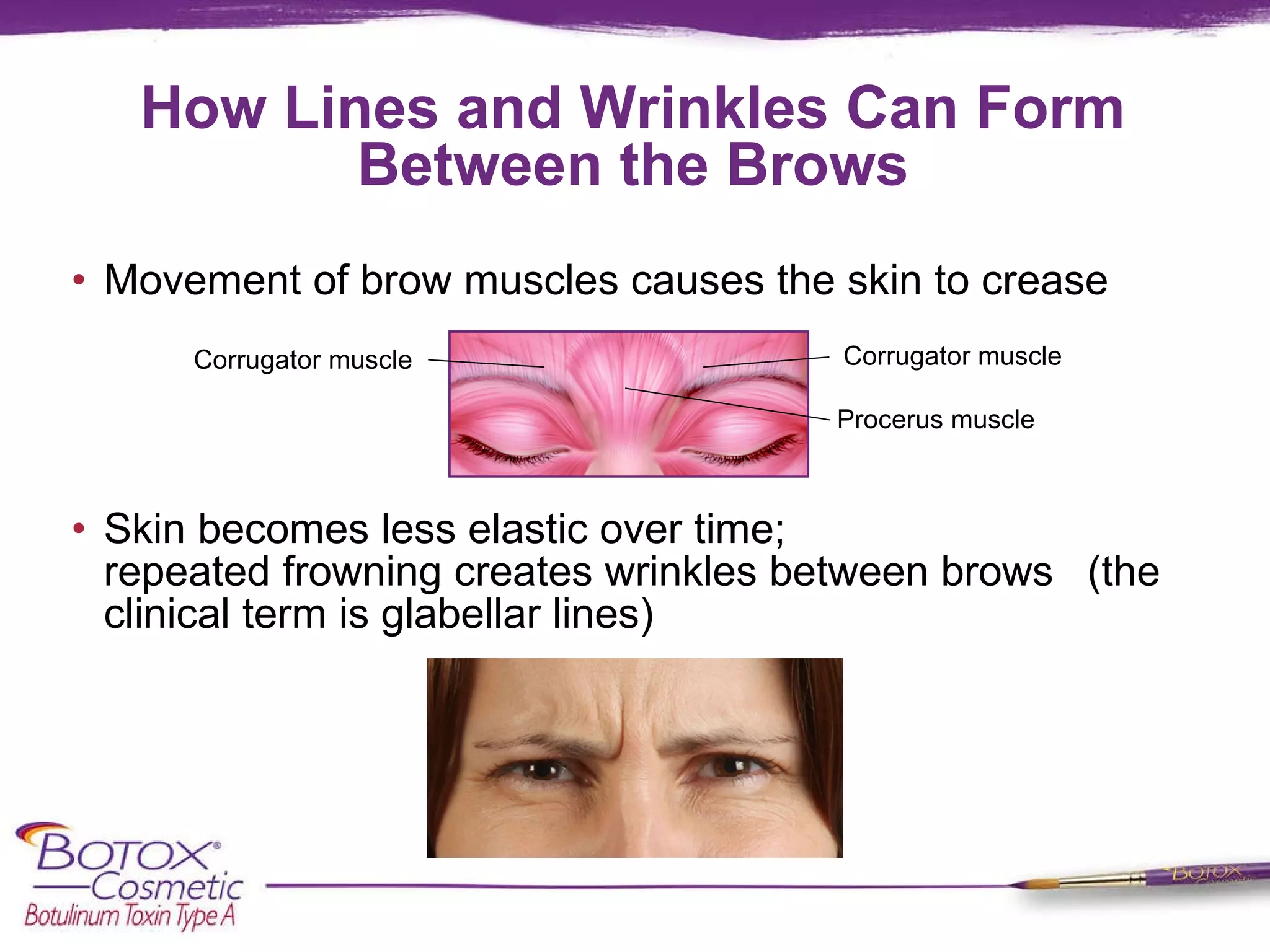 How Lines and Wrinkles Can Form Between the Brows Movement of brow muscles causes the skin to crease Skin becomes less elastic over time;  repeated frowning creates wrinkles between brows  (the clinical term is glabellar lines)  Corrugator muscle Corrugator muscle  Procerus muscle 