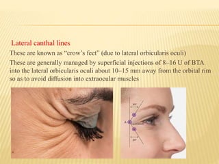 Lateral canthal lines
These are known as “crow’s feet” (due to lateral orbicularis oculi)
These are generally managed by superficial injections of 8–16 U of BTA
into the lateral orbicularis oculi about 10–15 mm away from the orbital rim
so as to avoid diffusion into extraocular muscles
 