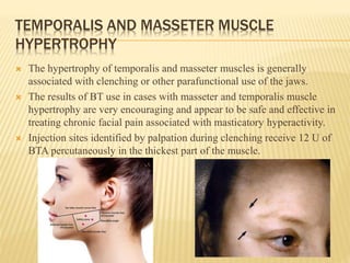 TEMPORALIS AND MASSETER MUSCLE
HYPERTROPHY
 The hypertrophy of temporalis and masseter muscles is generally
associated with clenching or other parafunctional use of the jaws.
 The results of BT use in cases with masseter and temporalis muscle
hypertrophy are very encouraging and appear to be safe and effective in
treating chronic facial pain associated with masticatory hyperactivity.
 Injection sites identified by palpation during clenching receive 12 U of
BTA percutaneously in the thickest part of the muscle.
 